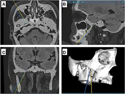 Robot-Assisted Percutaneous Balloon Compression for Trigeminal Neuralgia: Technique Description and Short-Term Clinical Results